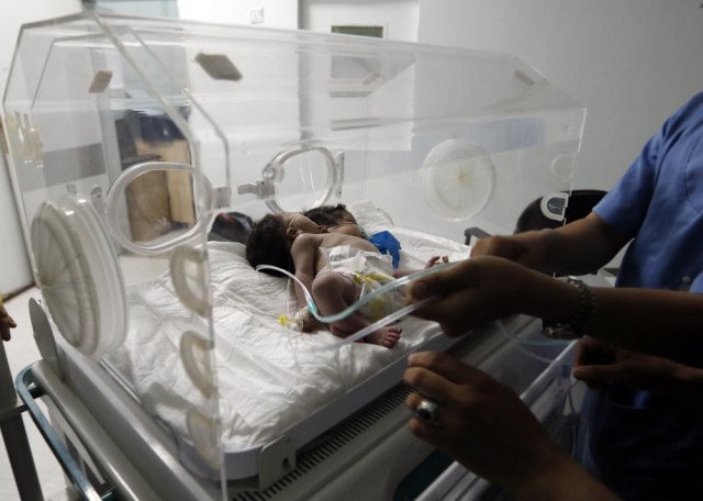 Lekari iz Brazila uspešno razdvojili sijamske blizance spojene mozgovima VIDEO